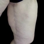 Thighplasty Before & After Patient #24093