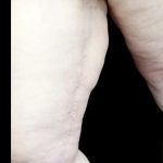 Thighplasty Before & After Patient #24093