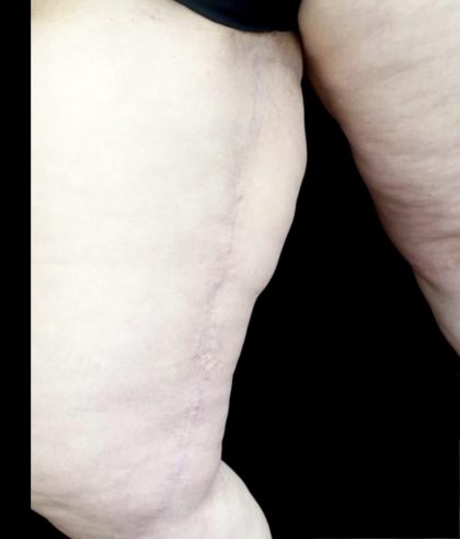 Thighplasty Before & After Patient #24093