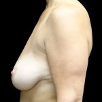 Breast Lift with Implants Before & After Patient #24010