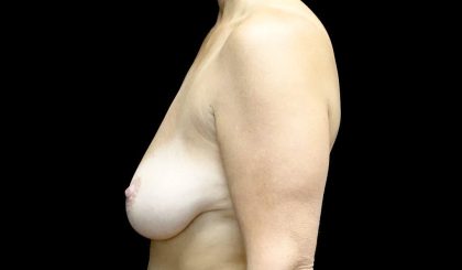 Breast Lift with Implants Before & After Patient #24010