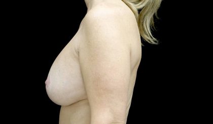 Breast Lift with Implants Before & After Patient #24010