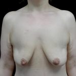 Breast Lift with Implants Before & After Patient #24079
