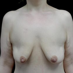Breast Lift with Implants Before & After Patient #24079