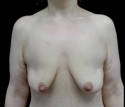 Breast Lift with Implants Before & After Patient #24079