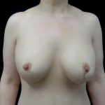 Breast Lift with Implants Before & After Patient #24079
