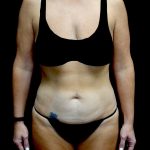 Tummy Tuck Before & After Patient #24011