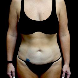 Tummy Tuck Before & After Patient #24011