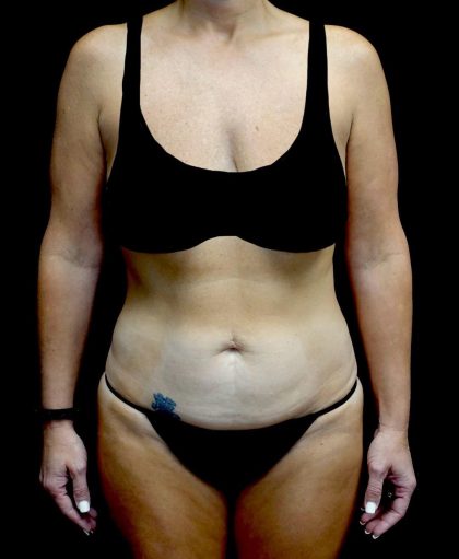 Tummy Tuck Before & After Patient #24011