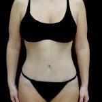 Tummy Tuck Before & After Patient #24011