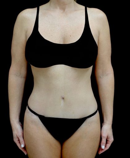Tummy Tuck Before & After Patient #24011