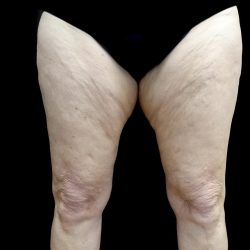 Thighplasty Before & After Patient #24072