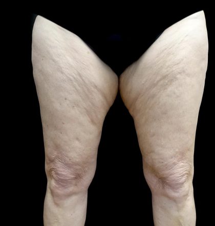 Thighplasty Before & After Patient #24072