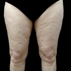 Thighplasty Before & After Patient #24072