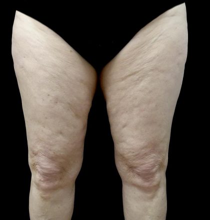 Thighplasty Before & After Patient #24072