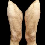 Thighplasty Before & After Patient #24094