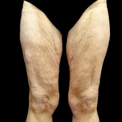 Thighplasty Before & After Patient #24094