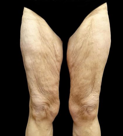 Thighplasty Before & After Patient #24094