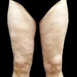 Thighplasty Before & After Patient #24094