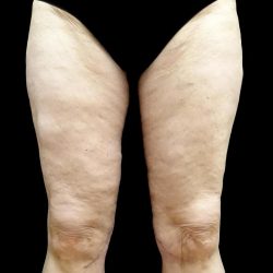 Thighplasty Before & After Patient #24094