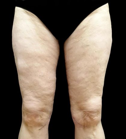 Thighplasty Before & After Patient #24094