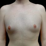Gynecomastia Before & After Patient #23981