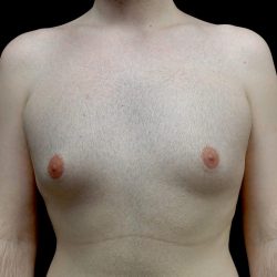 Gynecomastia Before & After Patient #23981
