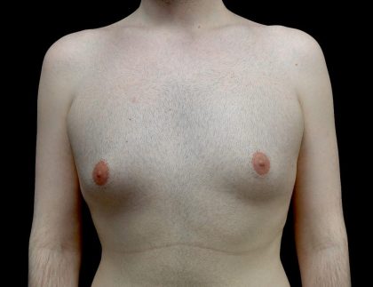 Gynecomastia Before & After Patient #23981