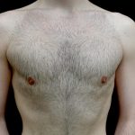 Gynecomastia Before & After Patient #23981