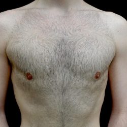 Gynecomastia Before & After Patient #23981