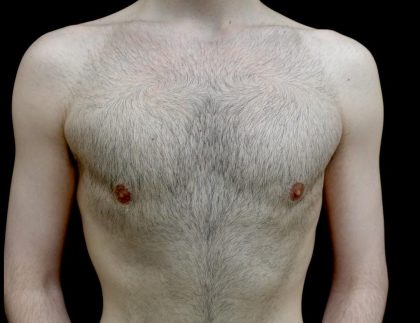 Gynecomastia Before & After Patient #23981
