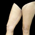 Thighplasty Before & After Patient #24071