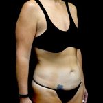 Tummy Tuck Before & After Patient #24011