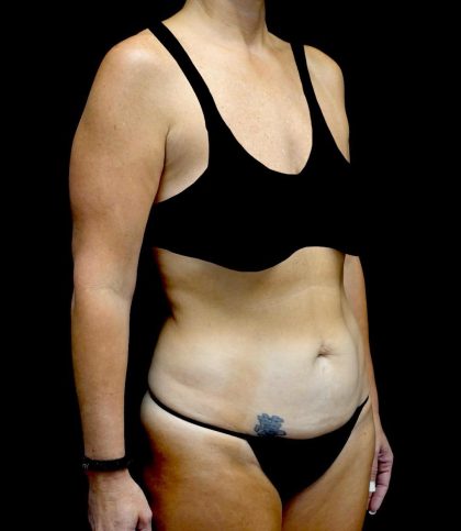 Tummy Tuck Before & After Patient #24011