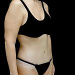 Tummy Tuck Before & After Patient #24011