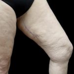 Thighplasty Before & After Patient #24072