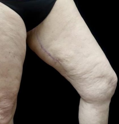 Thighplasty Before & After Patient #24072