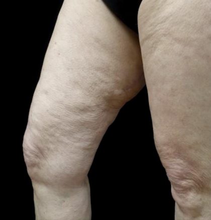 Thighplasty Before & After Patient #24072