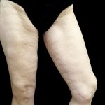 Thighplasty Before & After Patient #24094