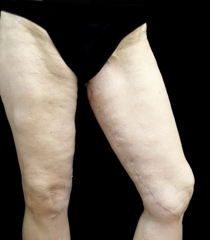 Thighplasty Before & After Patient #24094