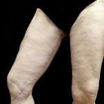 Thighplasty Before & After Patient #24094