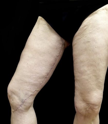Thighplasty Before & After Patient #24094