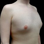 Gynecomastia Before & After Patient #23981