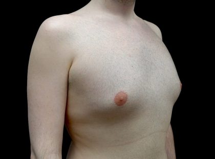 Gynecomastia Before & After Patient #23981