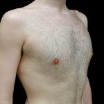 Gynecomastia Before & After Patient #23981