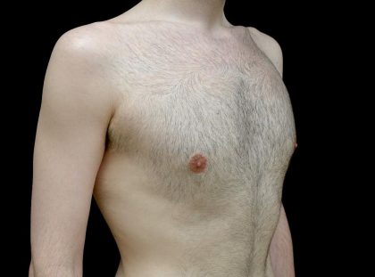 Gynecomastia Before & After Patient #23981