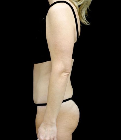 Tummy Tuck Before & After Patient #24011