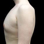 Gynecomastia Before & After Patient #23981