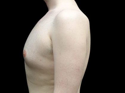 Gynecomastia Before & After Patient #23981
