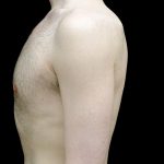 Gynecomastia Before & After Patient #23981